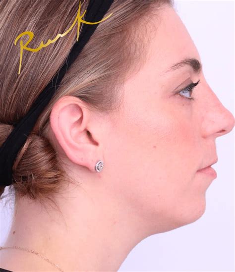 Kybella® Overview: Cost, Recovery, Before & After .